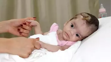 Mezarlığa Bırakılan 2 Beyin Ameliyatı Olan 'Kader' Bebek, Yaşama Tutundu