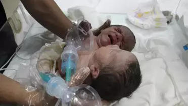 Suriye'de Çift Başlı Bebek Dünyaya Geldi