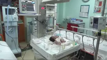 Suriye'de Çift Başlı Bebek Dünyaya Geldi