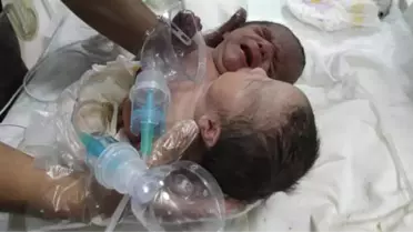 Suriye'de Doğan Çift Başlı Bebek, Türkiye'ye Getirildi