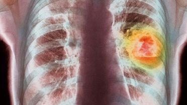 İskoçya'da Yapılan Araştırma: 'Altın Zerrecikleri Kanser İlaçlarının Etkisini Artırabilir'