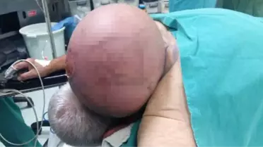 50 Yıldır Ensesinde Taşıdığı Kitle, Doktorları Bile Hayrete Düşürdü