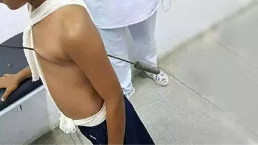 Kalbine Kebap Şişi Saplandı, Mucizevi Bir Şekilde Kurtuldu
