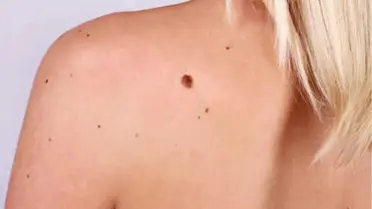 Güneş Lekelerine Doğal Maske Tarifleri