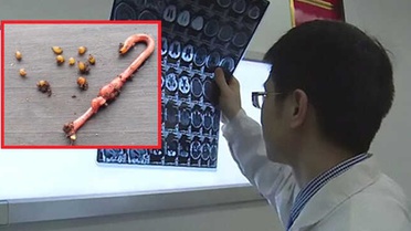 Az Pişmiş Domuz Eti Yiyen Adamın Beyninde 30 Tenya Yumurtası Bulundu