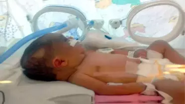 Kafatası Çatlayan 6 Günlük Bebek, Yaşam Savaşı Veriyor