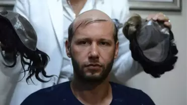 Protez Saça İlgi Artıyor