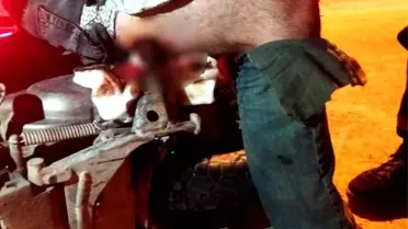 Doktorlarda Şok Oldu: Motosikletin Ayaklığı Bacağına Saplandı