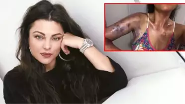 Evinde düdüklü tencere patlayan gelin adayı Sinem Umaş'ın vücudu yandı