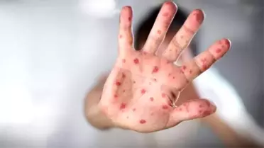 Çocuklarda el, ayak ve ağız hastalığı hastalığına dikkat