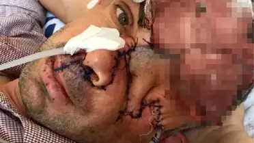 Dişini çektirdikten sonra sol gözünü kaybetti iddiasına yalanlama