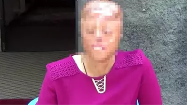 1,5 aylıkken yüzü yanan genç kız, yeni bir yüz istiyor