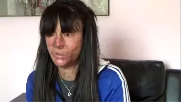 Yüzü asitle yakılan Berfin'den mütalaa tepkisi: Benim yerimde kızınız olsaydı