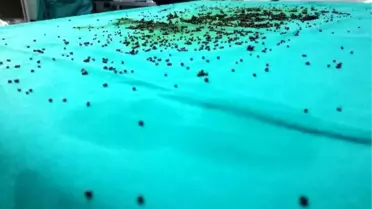 Safra kesesinden 3 bin 765 taş çıktı