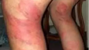 Ustasından kayışıyla dayak yiyen çocuk, psikolojik tedavi görüyor
