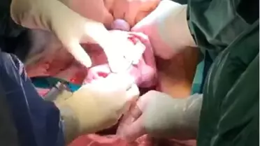 Göbek kordonu kesilmeden ameliyat edilen bebek, sağlıklı şekilde dünyaya geldi