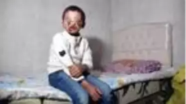 Gün ışığına çıkamayan, küçük Salih'in yüzü iyileşmeye başladı