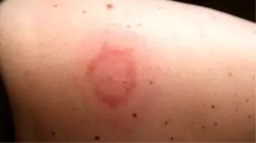 Böcek Isırığı Nasıl Olur ve Nasıl Anlaşılır? Böcek Isırığı Nasıl Geçer ve Ne İyi Gelir?