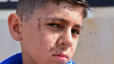 Arkadaşının döktüğü temizlik malzemesi Yiğit Ali'nin yüzünü yaktı