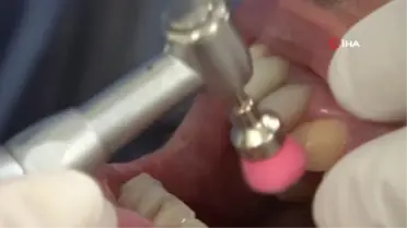 Dişleri beyazlatmada sosyal medya önerileri sağlığınıza zarar verebilir