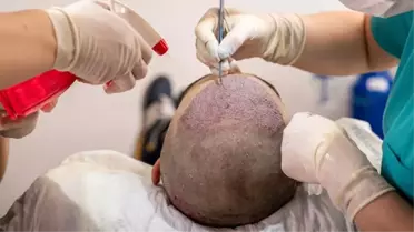 İngilizlerin saç ektirme oyunu! Türkiye'deki seyahat yasağını delip tatil yapıyorlar