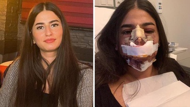 Burun estetiği sonucu hayatı kararan kadının doktoru: Düğün hediyem olsun