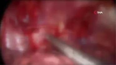 Ameliyatla aşırı terlemeden kurtulmak mümkün