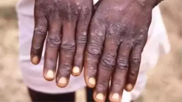 Korku yaratan maymun çiçeği virüsü İsviçre'ye de sıçradı