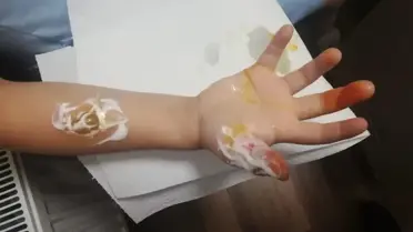 MR çekilen küçük kızın parmakları ve kolu yandı