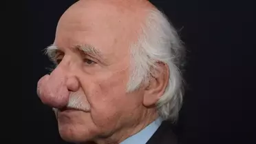Burnundaki kitle 100 grama ulaştı! Nefes alamayınca ameliyat edildi