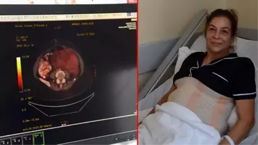 Tam 10 kilo! Şişkinlik için gittiği hastanede karnından çıkarıldı