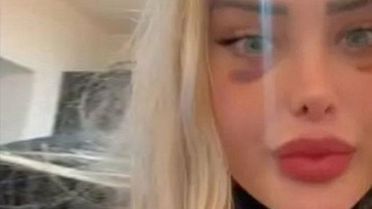 Ameliyat olup uçağa binen TikTok fenomeninin kafatasında çatlaklar oluştu