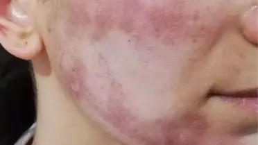 Cansu'nun yüzünü yakan güzellik merkezi sorumlularına ceza