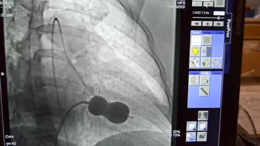 Alanya'da mitral kalp kapağı darlığı ameliyatsız tedavi edildi
