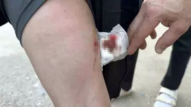 Sakarya'da Köpek Saldırısına Uğrayan Kız Çocuğu Okula Gitmeye Korkuyor