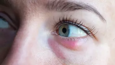 Arpacık nedir, neden oluşur? Arpacık nasıl geçer?