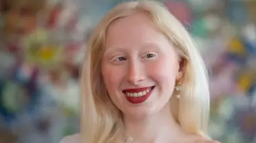 Albino Sosyal Medya Fenomeni Ayşenur Sena Tarakçı, Albinizm Hakkında Farkındalık Oluşturuyor