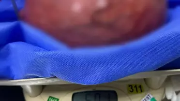 Trabzon'da 5,5 Kilogramlık Kitle Ameliyatla Alındı