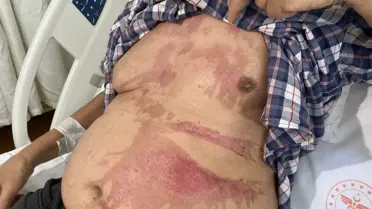 78 yaşındaki adamın kullandığı lavabo açıcı patladı: Vücudunun bir bölümü yandı