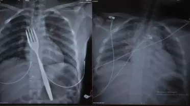 Genç Kız Çatal Yuttu, Operasyonla Kurtarıldı