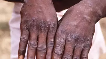 Uganda'da M Çiçeği salgınında can kaybı sayısı 37'ye yükseldi