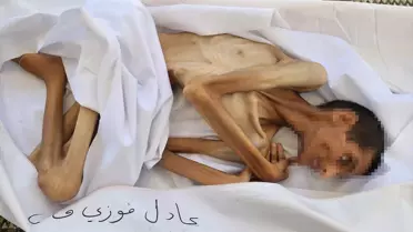 Gazze'de Açlık Sebebiyle Bir Kişi Daha Hayatını Kaybetti