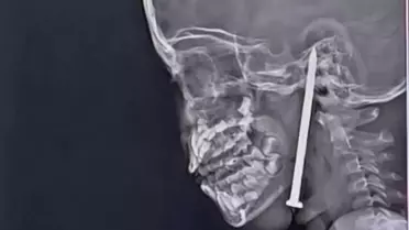 Beynine çivi saplanan küçük kız mucizevi şekilde kurtarıldı
