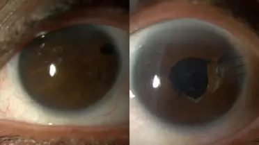 Göz Ameliyatı ile Şirin Kılıç'ın Hayatı Değişti