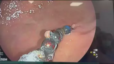 Doktorları bile şoke eden vaka: Karnında 66 adet mıknatısla aylarca hayatta kaldı