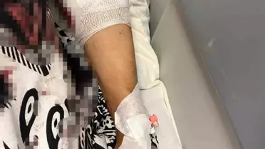 Kartepe'de Kadına Köpek Saldırısı