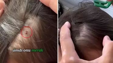 Baba, kızının kafasına yapışan keneyi böyle kopardı