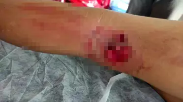 Köpek Saldırısı: 8 Yaşındaki Çocuk Yaralandı