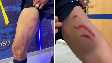 Stuttgart maçında tekme yiyen Fenerli yıldızın son hali inanılmaz