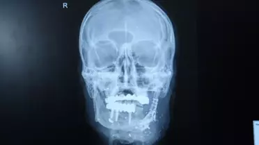 Ateşli Silah Yaralanması Sonrası Başarı